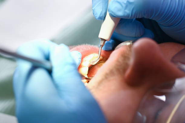 Best Emergency Dentist for Lost Fillings or Crowns in Rancho Cordova, CA